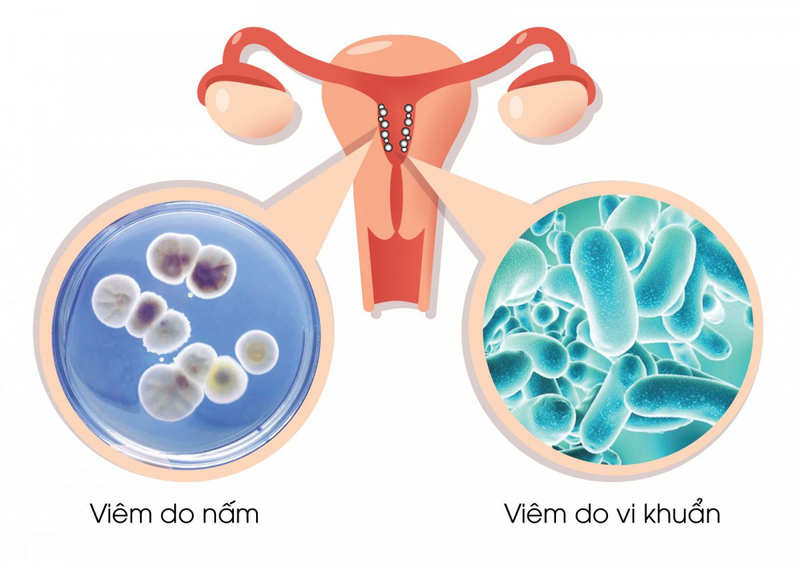 Nấm và vi khuẩn là nguyên nhân chủ yếu gây viêm âm đạo