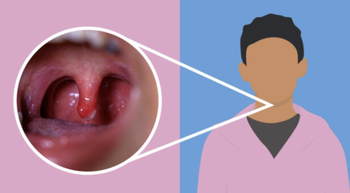Khám thấy lưỡi gà bị sưng là dấu hiệu chẩn đoán viêm lưỡi gà
