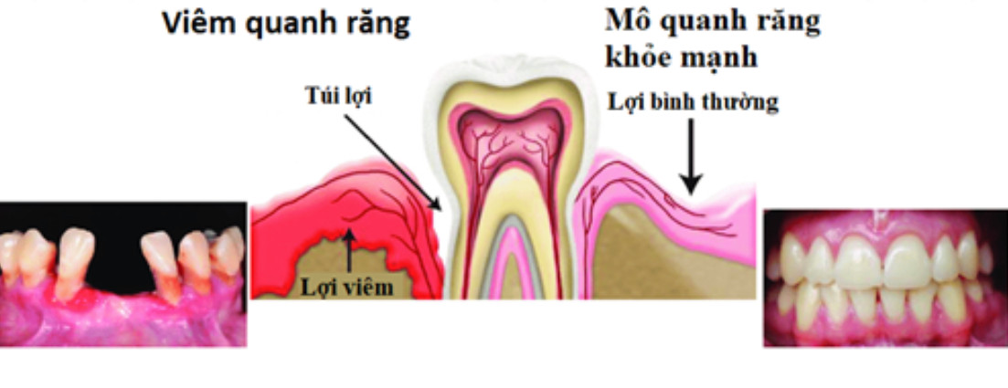 Viêm quanh răng là gì? Những điều cần biết về viêm quanh răng