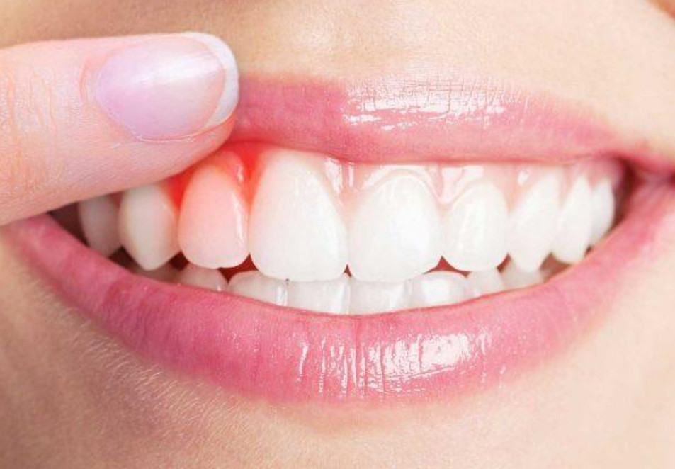 Triệu chứng của viêm quanh răng có thể là nướu có màu đỏ tươi hoặc đỏ sẫm