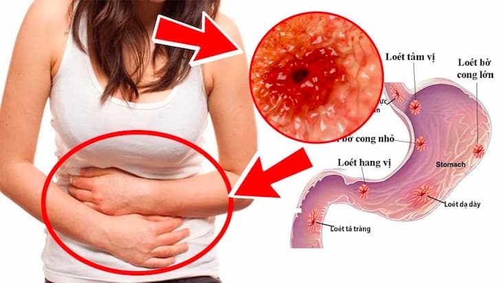 Loét dạ dày gây đau vùng thượng vị, khó chịu và ảnh hưởng đến chức năng tiêu hóa 