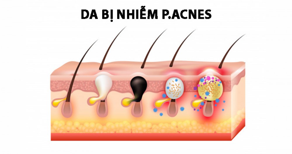 Vi khuẩn P. Acnes gây nên mụn bọc