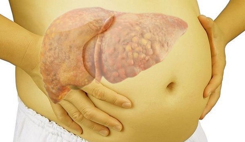 Tuân thủ các khuyến cáo từ nhân viên y tế để phòng ngừa xơ gan hiệu quả