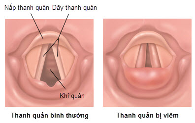 Hình ảnh viêm thanh quản.