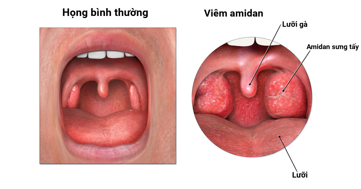 Hình ảnh viêm amidan.