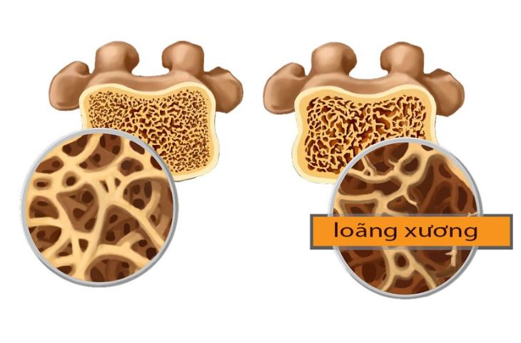                                           Hội chứng Cushing gây loãng xương 