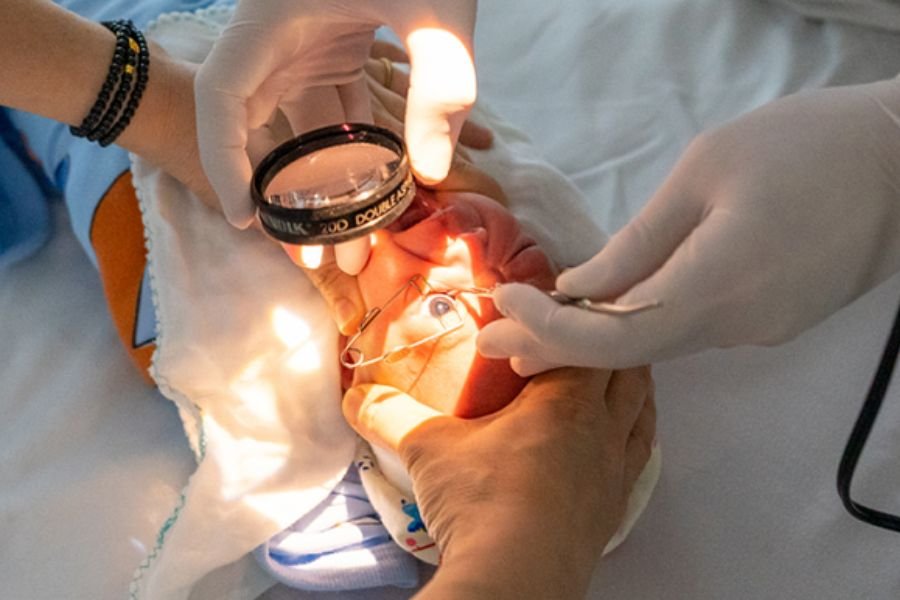 Trẻ sinh non có nguy cơ bị xuất huyết võng mạc cao