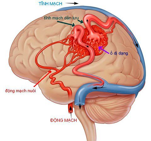 Dị dạng mạch não là nguyên nhân chủ yếu dẫn đến xuất huyết não
