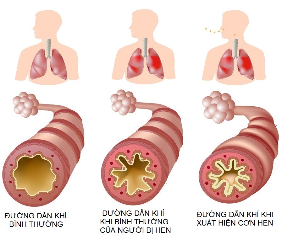 Bệnh hen suyễn là bệnh mạn tính gây sưng, viêm đường hô hấp