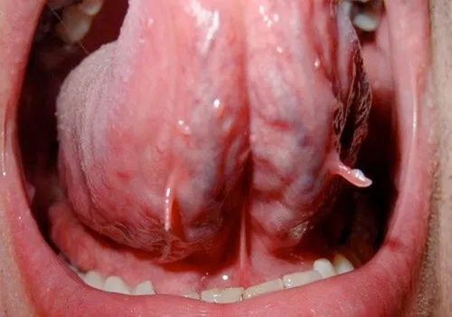 Cuống lưỡi nổi mụn thịt