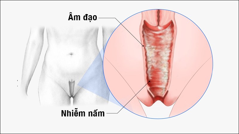 Nấm Candida phát triển quá mức gây ra tình trạng nấm âm đạo