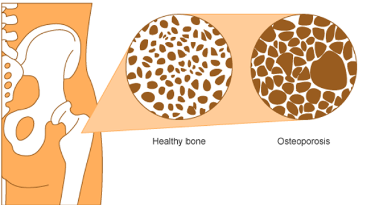 Loãng xương ảnh hưởng lớn đến đời sống sinh hoạt hằng ngày