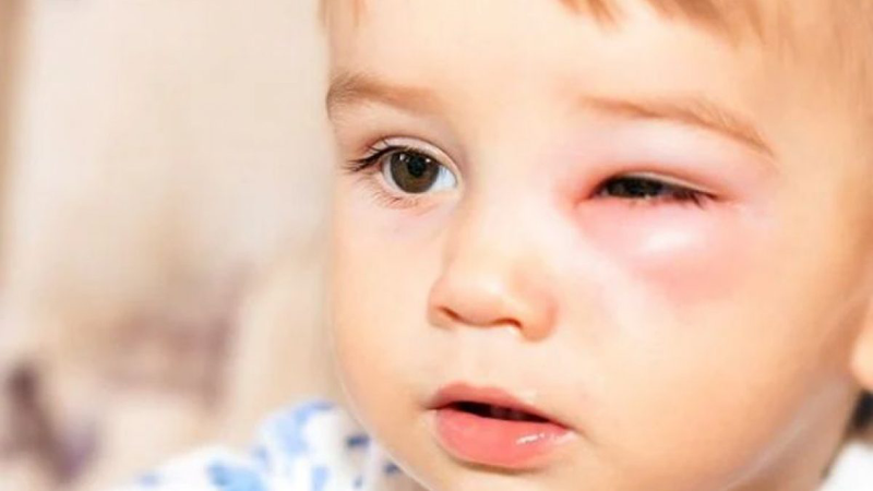 Mắt sưng sau khi khóc do tích tụ dịch và tăng lưu lượng máu quanh vùng mắt Khi bạn khóc, tuyến lệ hoạt động mạnh để sản xuất nước mắt nhằm phản ứng với cảm xúc. Lượng nước mắt tiết ra nhiều hơn bình thường sẽ khiến vùng quanh mắt bị ứ đọng dịch tạm thời, dẫn đến tình trạng sưng phù. Đây là nguyên nhân phổ biến nhất khiến mắt bị sưng sau khi khóc. Bên cạnh đó, khi khóc, các mạch máu dưới da quanh mắt sẽ giãn ra để tăng lưu lượng máu, khiến vùng da trở nên đỏ và nhạy cảm hơn. Việc gia tăng tuần hoàn máu kết hợp với tích tụ dịch khiến mắt dễ bị sưng rõ rệt, đặc biệt là ở mí trên và mí dưới. Một yếu tố khác góp phần làm tình trạng này nghiêm trọng hơn là thói quen dụi mắt. Khi khóc, nhiều người có xu hướng dùng tay chà xát mắt để lau nước mắt, điều này có thể gây kích ứng, làm tổn thương lớp da mỏng quanh mắt và khiến tình trạng sưng kéo dài hơn. Ngoài ra, những người có cơ địa dễ giữ nước, thiếu ngủ hoặc đang trong trạng thái căng thẳng kéo dài cũng có nguy cơ bị sưng mắt nhiều hơn sau khi khóc. Vì vậy, việc hiểu rõ nguyên nhân sẽ giúp bạn lựa chọn cách xử lý phù hợp và hiệu quả hơn.