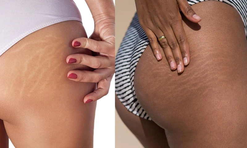 rạn da khi mang thai