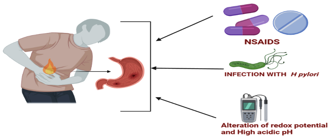 Có nhiều nguyên nhân dẫn đến Polyp dạ dày