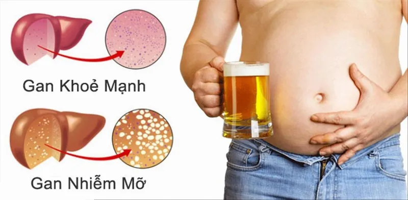 Bệnh gan thoái hóa mỡ là tình trạng mỡ tích tụ vượt quá mức cho phép trong các tế bào gan 