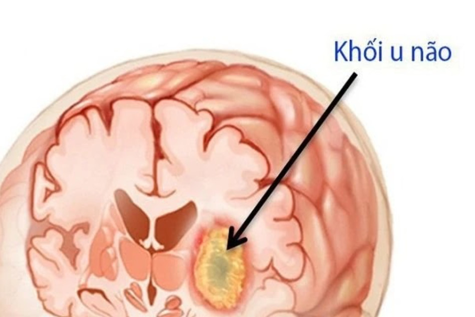 Hình ảnh khối u não