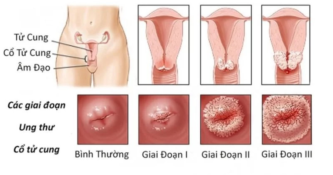 Bệnh không có tính di truyền nhưng virus gây bệnh lại dễ lây lan
