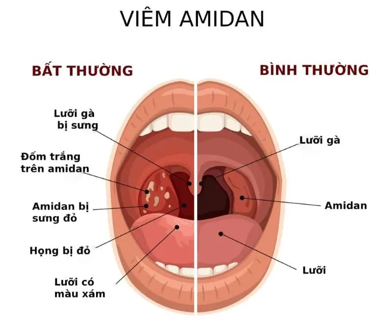 Viêm amidan