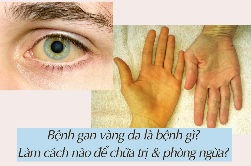 Dấu hiệu dễ nhận biết nhất của vàng da là sự thay đổi màu sắc da và lòng trắng mắt.