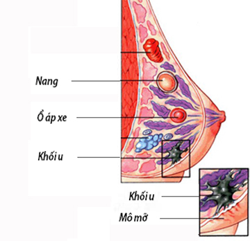 Hình ảnh áp xe vú