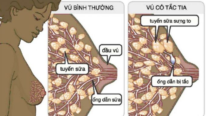 Vú có tắc tia sữa