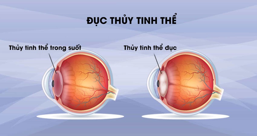 Mắt bị đục thủy tinh thể