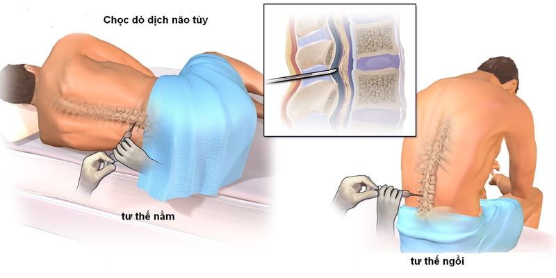 Khám phá sâu hội chứng rối loạn sinh tủy: nguyên nhân||