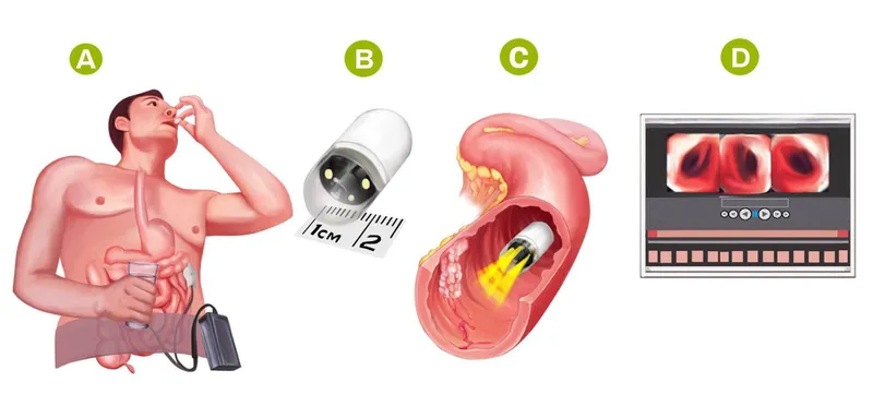 Ống nội soi mềm giúp quan sát rõ niêm mạc dạ dày
