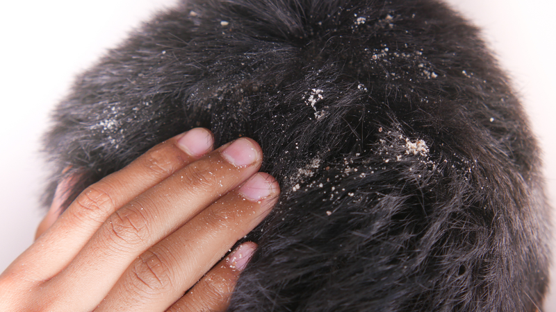 Nizoral Bôi Vùng Kín