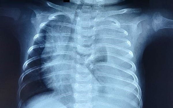 Bệnh màng trong ở trẻ sơ sinh: nguyên nhân, triệu chứng và phương pháp điều trị