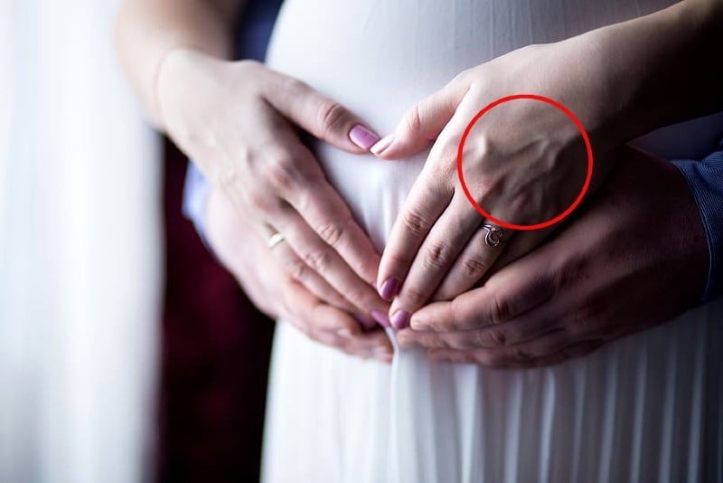 Tay nổi gân xanh có thể liên quan đến cấu trúc da hoặc hệ tĩnh mạch dưới da