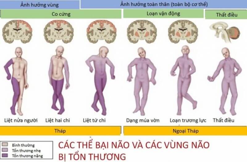 Các thể bại não và các vùng não bị tổn thương.