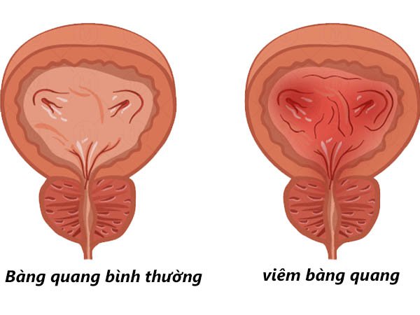 Viêm bàng quang có thể là nguyên nhân dẫn đến đi tiểu nhiều lần trong ngày