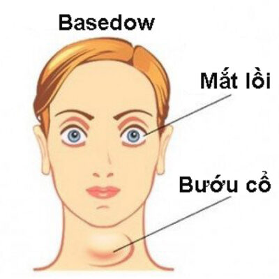 Bệnh Basedow