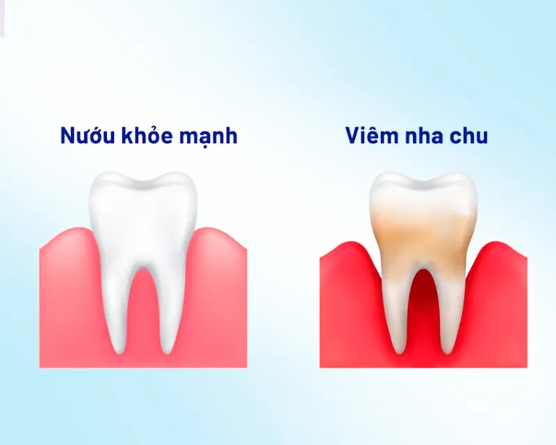 Hình minh họa vệ sinh răng miệng đúng cách
