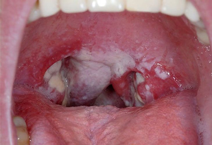 Bạch hầu là bệnh nhiễm trùng nhiễm độc cấp tính nguy hiểm có tốc độ lây lan nhanh 