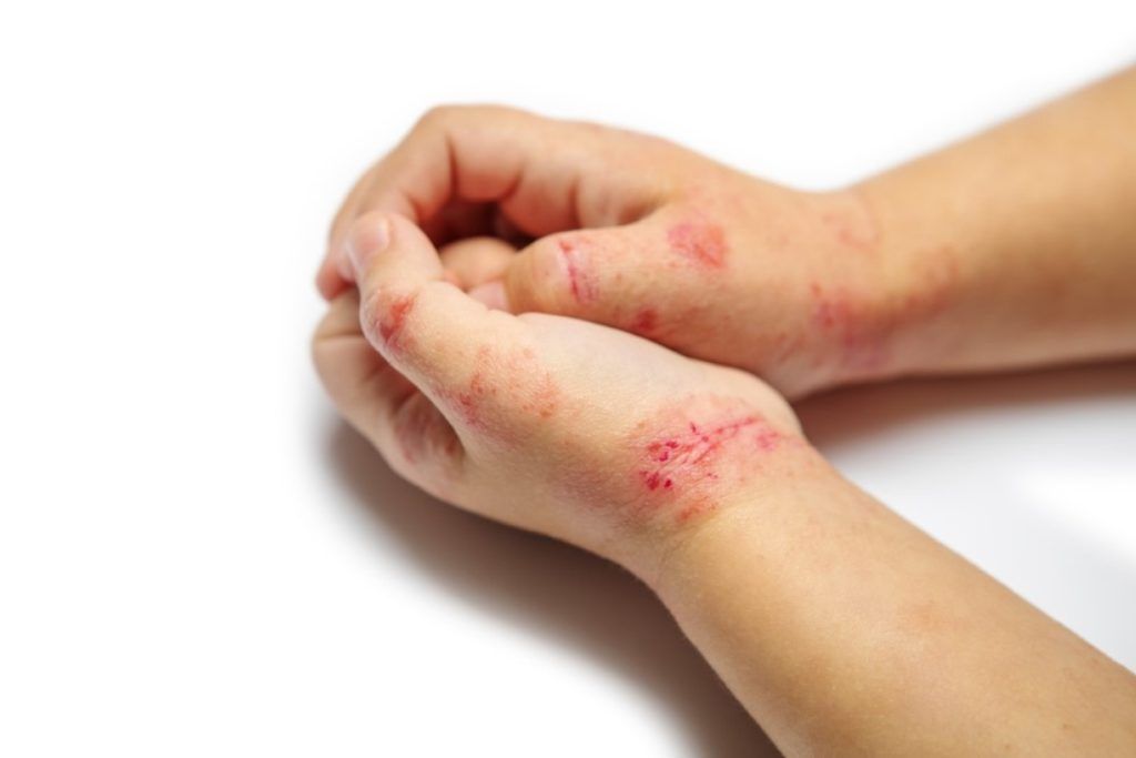 Giáo dục trẻ thực hiện lối sống sạch sẽ để tránh bị chốc loét