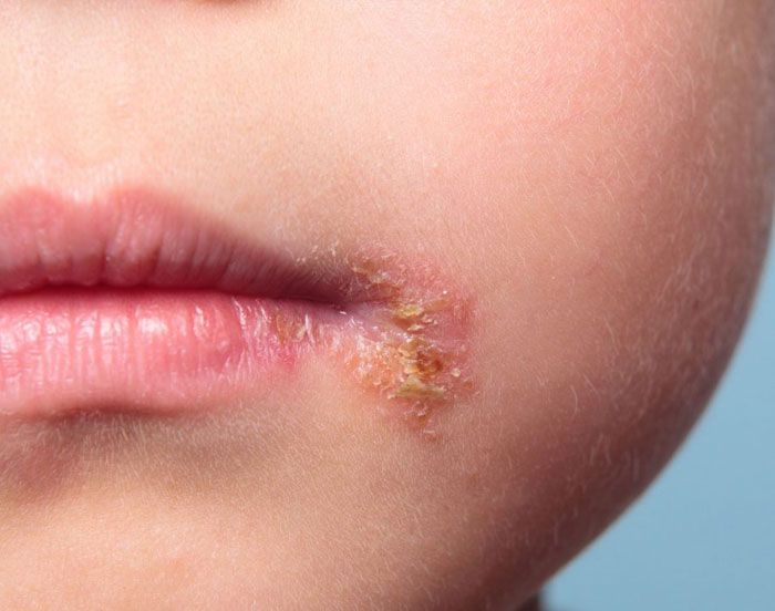 Các vết nứt nẻ ở khóe miệng gây khó khăn cho việc ăn uống và giao tiếp hàng ngày 