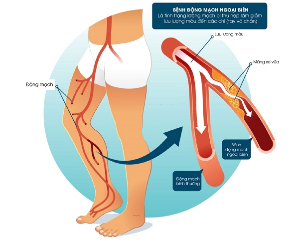 Bệnh lý tắc nghẽn mạch máu ngoại biên do mảng xơ vữa