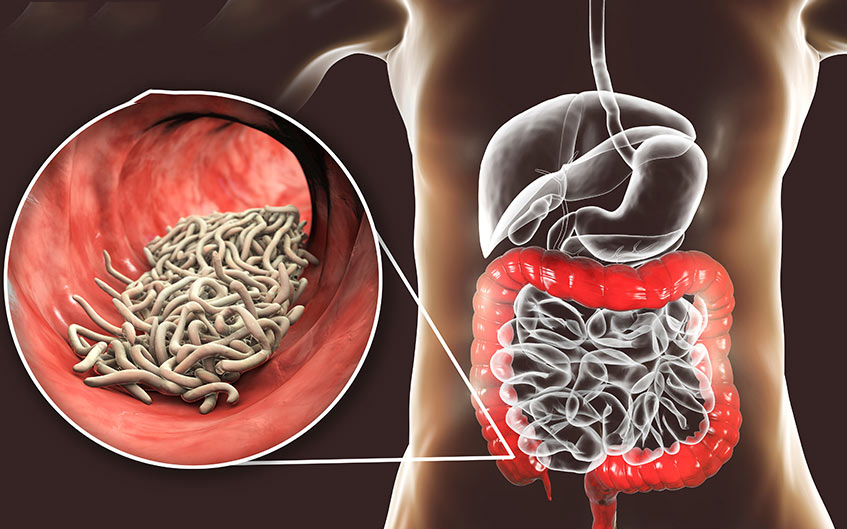 Lỵ trực khuẩn: Triệu chứng, nguyên nhân và điều trị