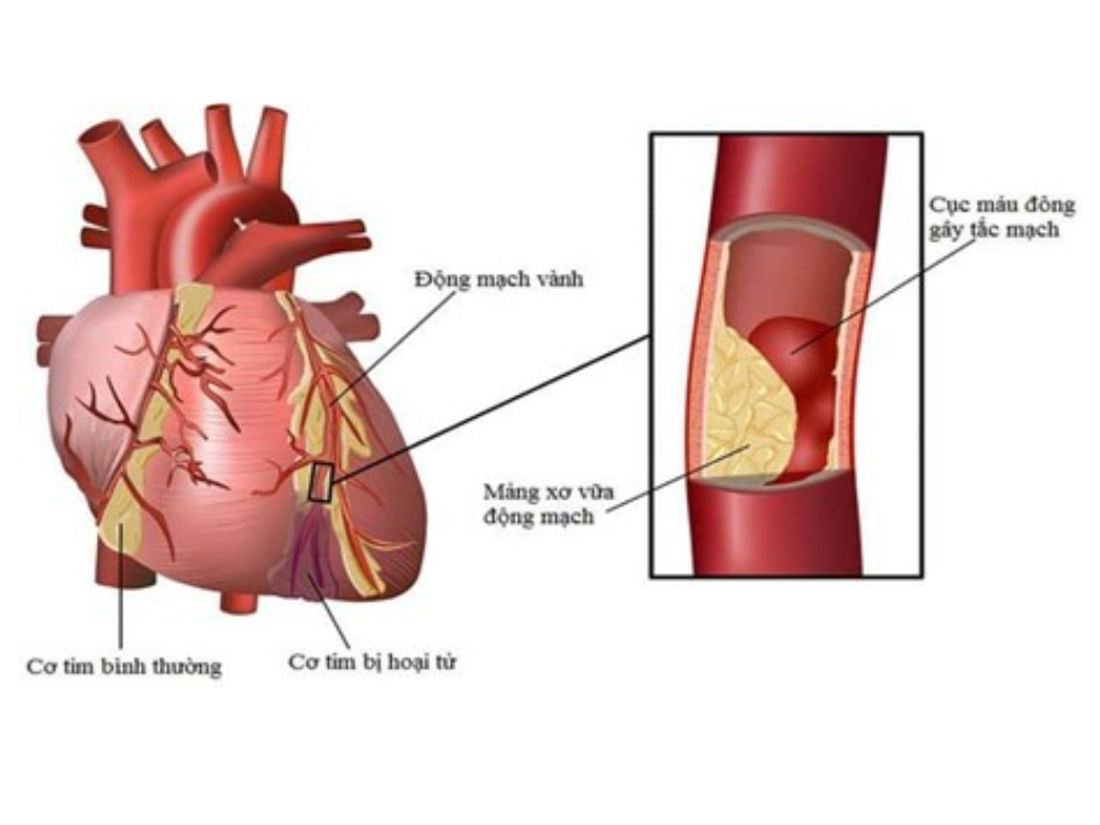 Bệnh mạch vành
