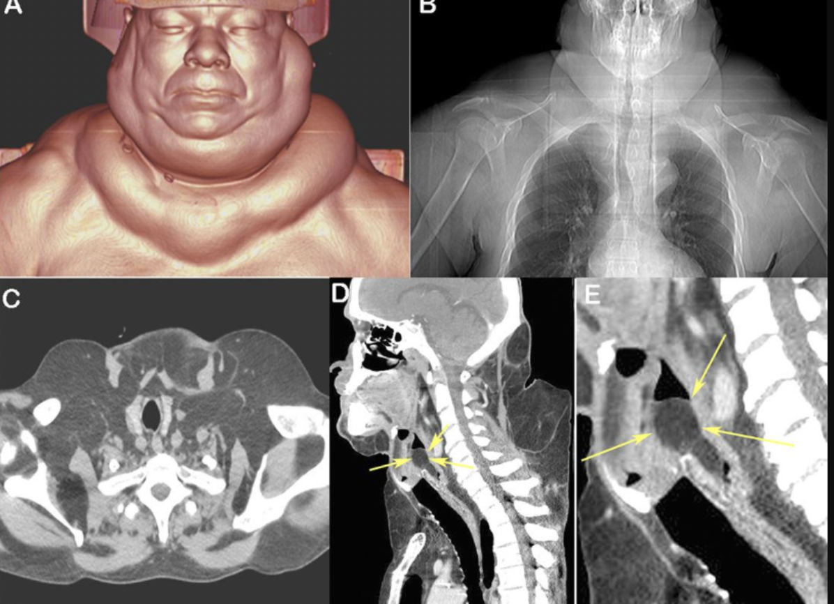 Chẩn đoán bệnh Madelung