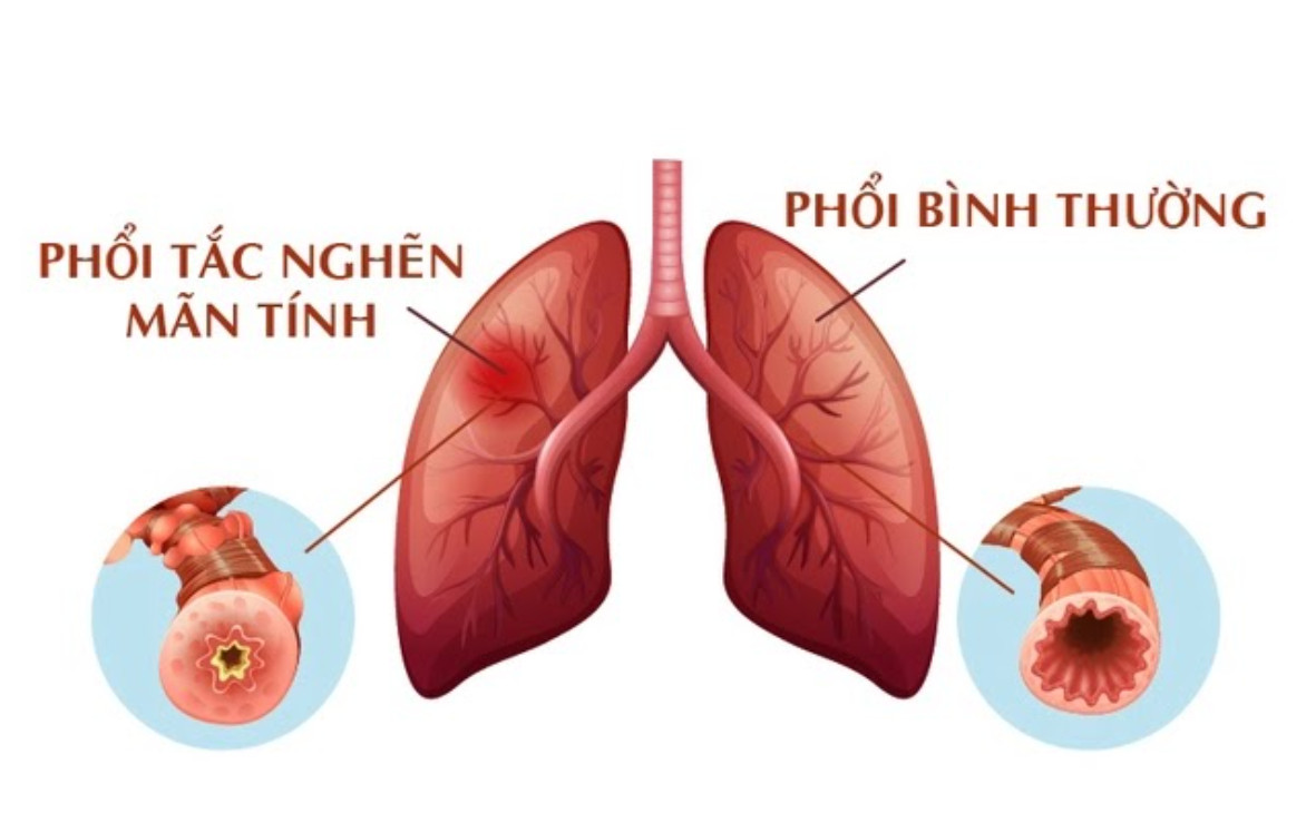 Phổi tắc nghẽn mãn tính và phổi thường