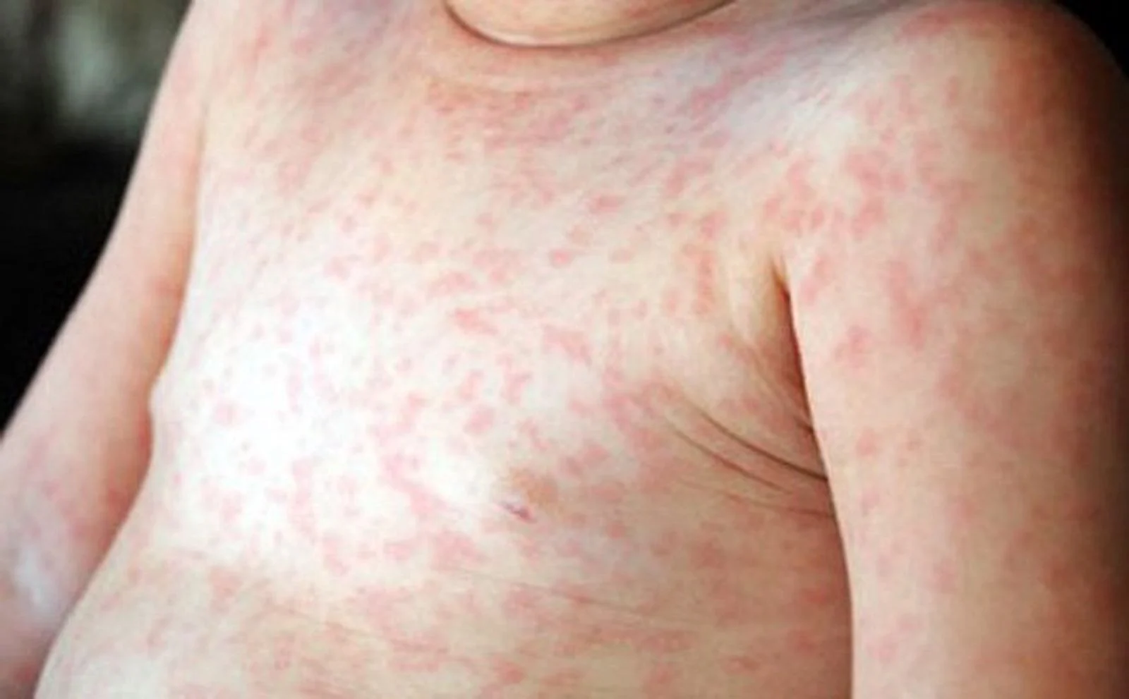 Giai đoạn toàn phát của bệnh Rubella với các nốt phát ban ban trên đầu, mặt, và toàn thân