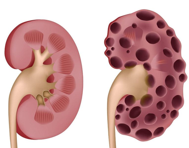 Bệnh thận đa nang