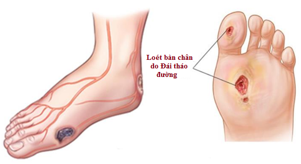 Loét bàn chân - một biến chứng nghiêm trọng của bệnh lý thần kinh đái tháo đường.