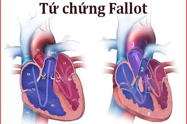 Tứ chứng Fallot là một bệnh tim bẩm sinh thường gặp.