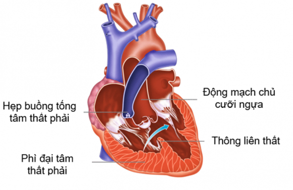 Phẫu thuật sửa chữa hoàn toàn tứ chứng Fallot 