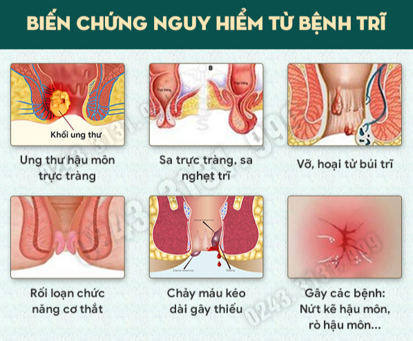 Các biến chứng của bệnh trĩ